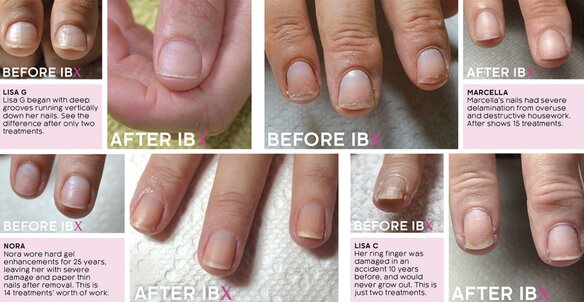 ibx treatment southend on sea